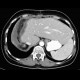 Compensatory enlargement of left liver lobe after resection of right liver lobe: CT - Computed tomography